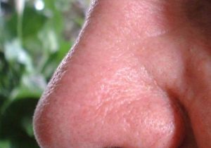 Perde il naso, glielo coltivano con uno stampo sul braccio
